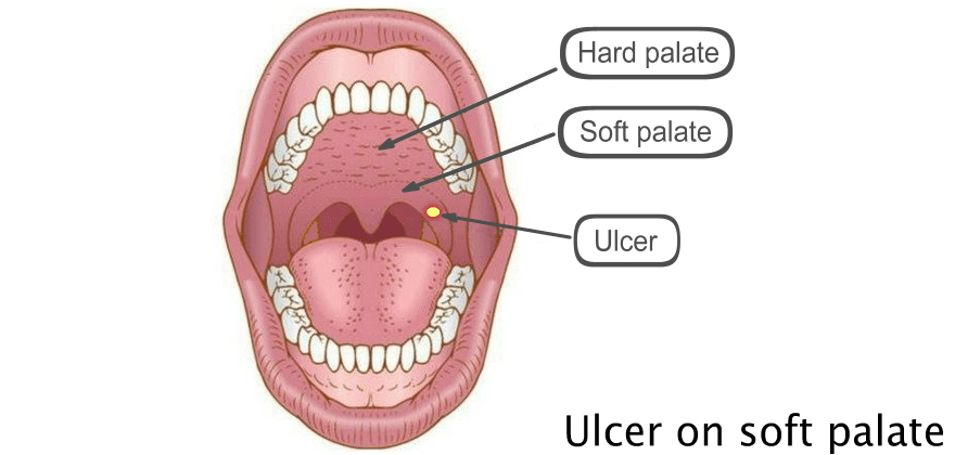 Ulcer on soft palate in mouth